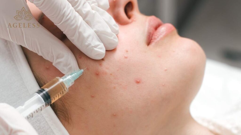 Non-ablative laser device used for acne and oil control