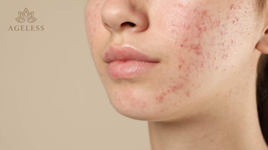 A dermatologist performing a chemical peel for acne treatment
