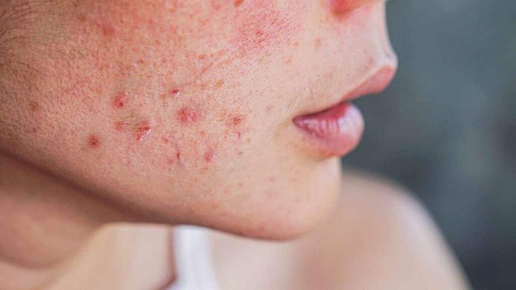 Inflamed cystic acne nodule beneath the skin surface