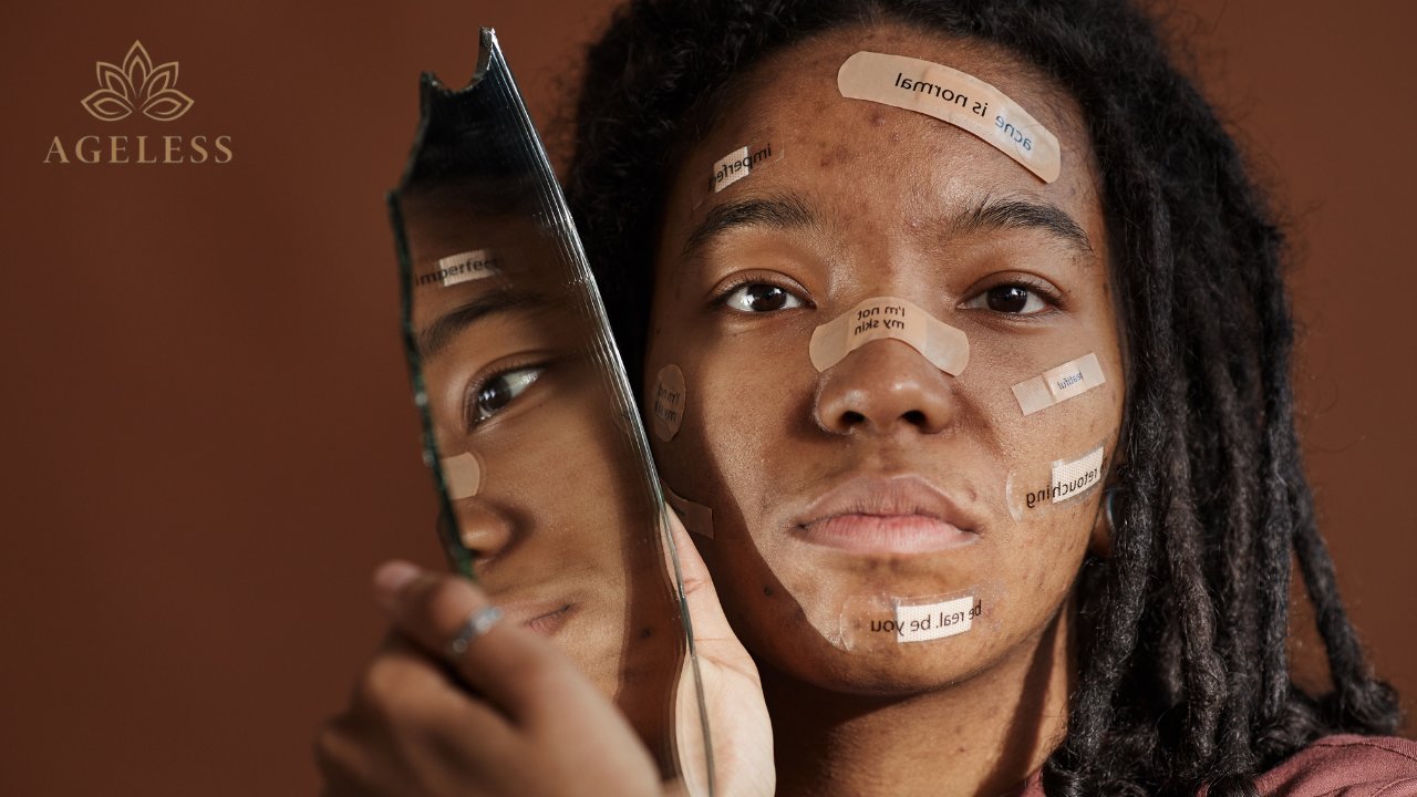 Acne Marks Removal in Tirupati