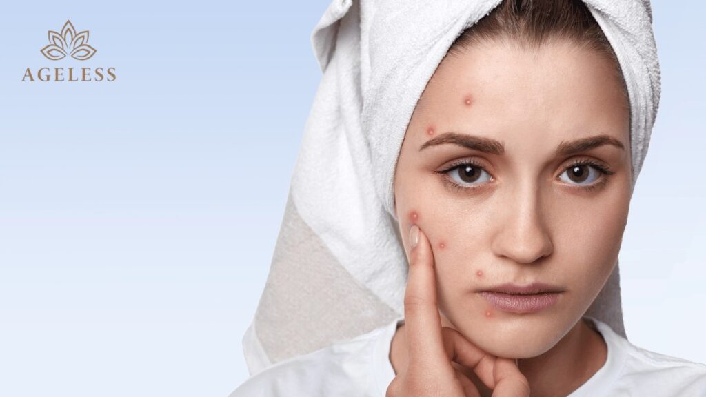 Best Pimple Treatment in Tirupati