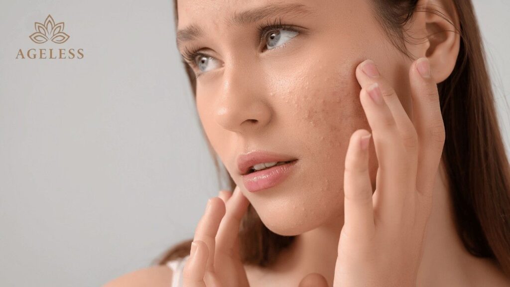 Best Acne Treatment in Tirupati