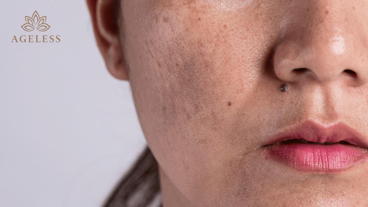 Dark Spots Removal in Tirupati