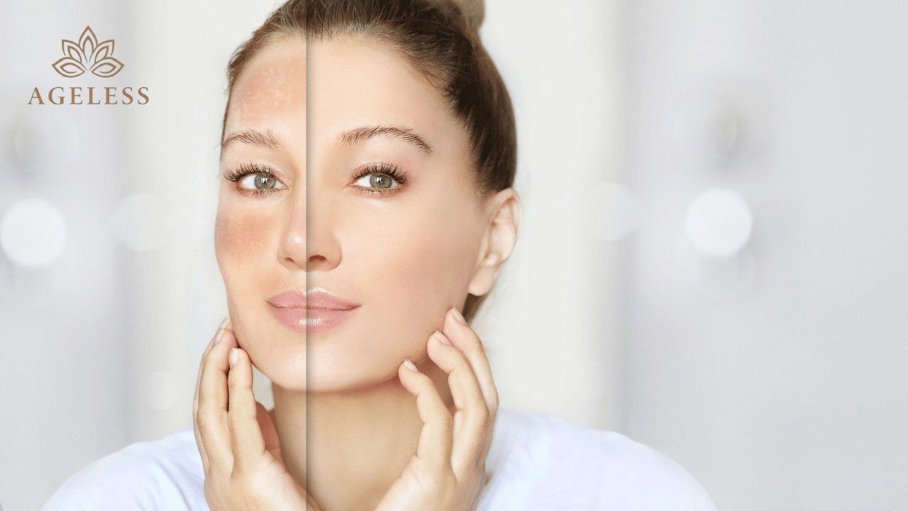 Melasma Treatment in Tirupati