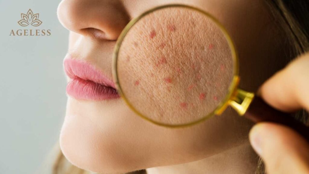 Why Does Your Acne Keep Coming Back? Skincare Isn’t Enough