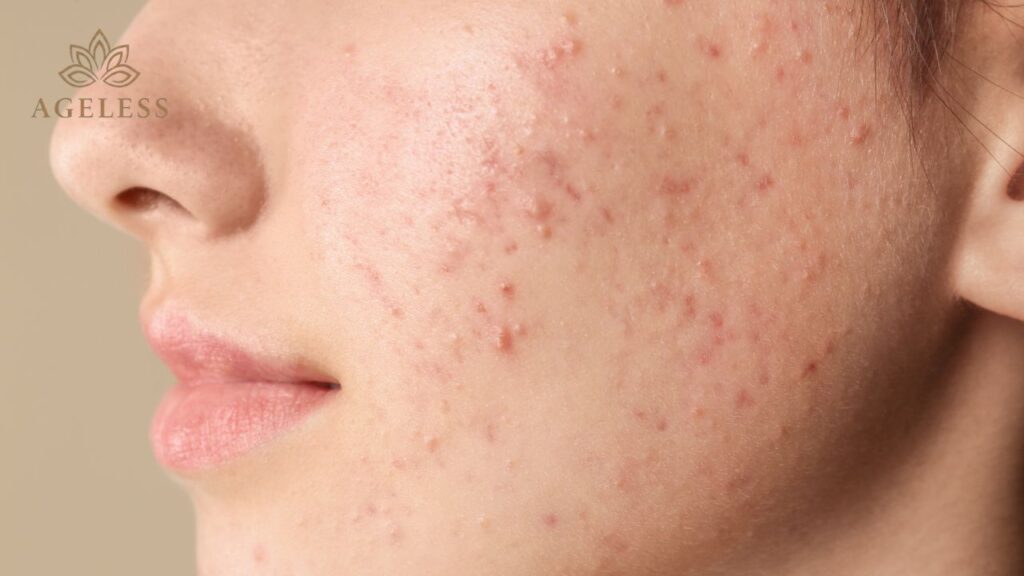 Best Acne Treatment in Tirupati: Comparing Treatment Approaches That Actually Clear Severe Acne